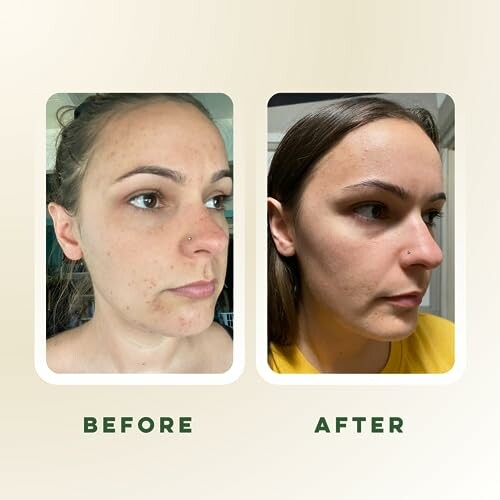 Before and after skin care comparison of a woman's face.